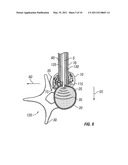 Spinous Navigation System and Associated Methods diagram and image