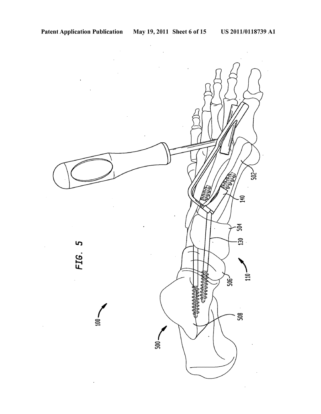 Intramedullary fixation assembly and method of use - diagram, schematic, and image 07