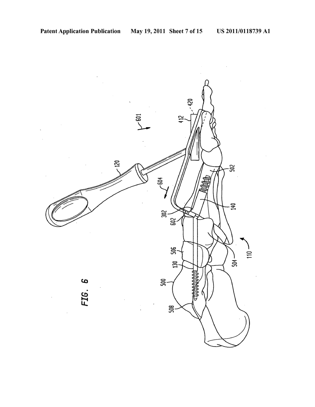 Intramedullary fixation assembly and method of use - diagram, schematic, and image 08
