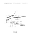 Intramedullary fixation assembly and method of use diagram and image