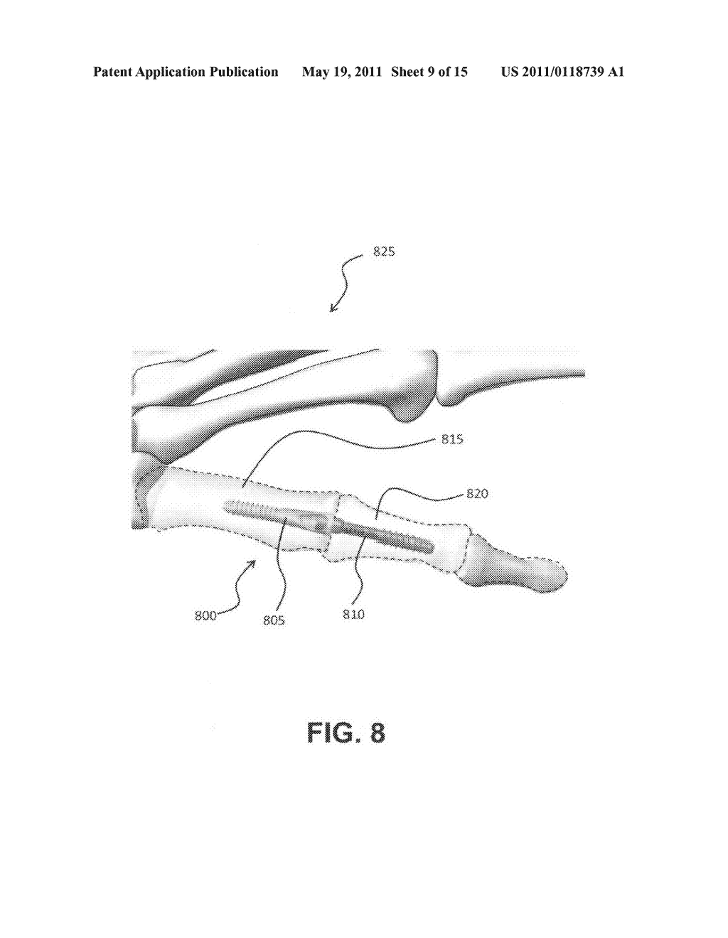 Intramedullary fixation assembly and method of use - diagram, schematic, and image 10