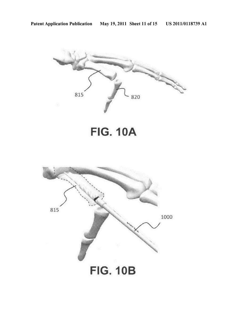 Intramedullary fixation assembly and method of use - diagram, schematic, and image 12