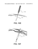 Intramedullary fixation assembly and method of use diagram and image