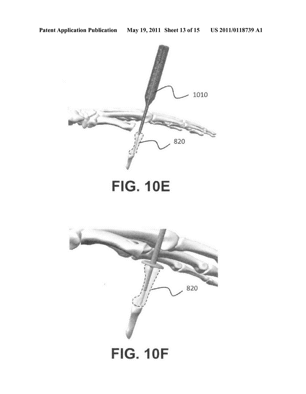 Intramedullary fixation assembly and method of use - diagram, schematic, and image 14