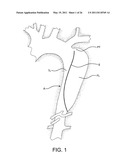 AORTIC DISSECTION SEPTAL CUTTING TOOL diagram and image