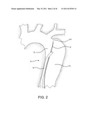 AORTIC DISSECTION SEPTAL CUTTING TOOL diagram and image