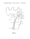 AORTIC DISSECTION SEPTAL CUTTING TOOL diagram and image