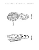 Article for alleviating bunion deformity and pain diagram and image