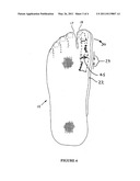 Article for alleviating bunion deformity and pain diagram and image
