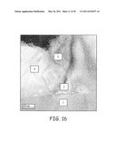 SILICON INKS FOR THIN FILM SOLAR CELL FORMATION, CORRESPONDING METHODS AND SOLAR CELL STRUCTURES diagram and image