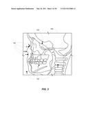 MARKER IDENTIFICATION AND PROCESSING IN X-RAY IMAGES diagram and image