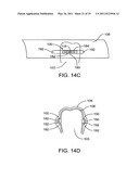 SYSTEMS AND METHODS FOR IMPROVED ENGAGEMENT BETWEEN ALIGNERS AND TEETH diagram and image