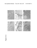 UTILITY OF HIGH MOLECULAR WEIGHT MELANOMA ASSOCIATED ANTIGEN IN DIAGNOSIS AND TREATMENT OF CANCER diagram and image