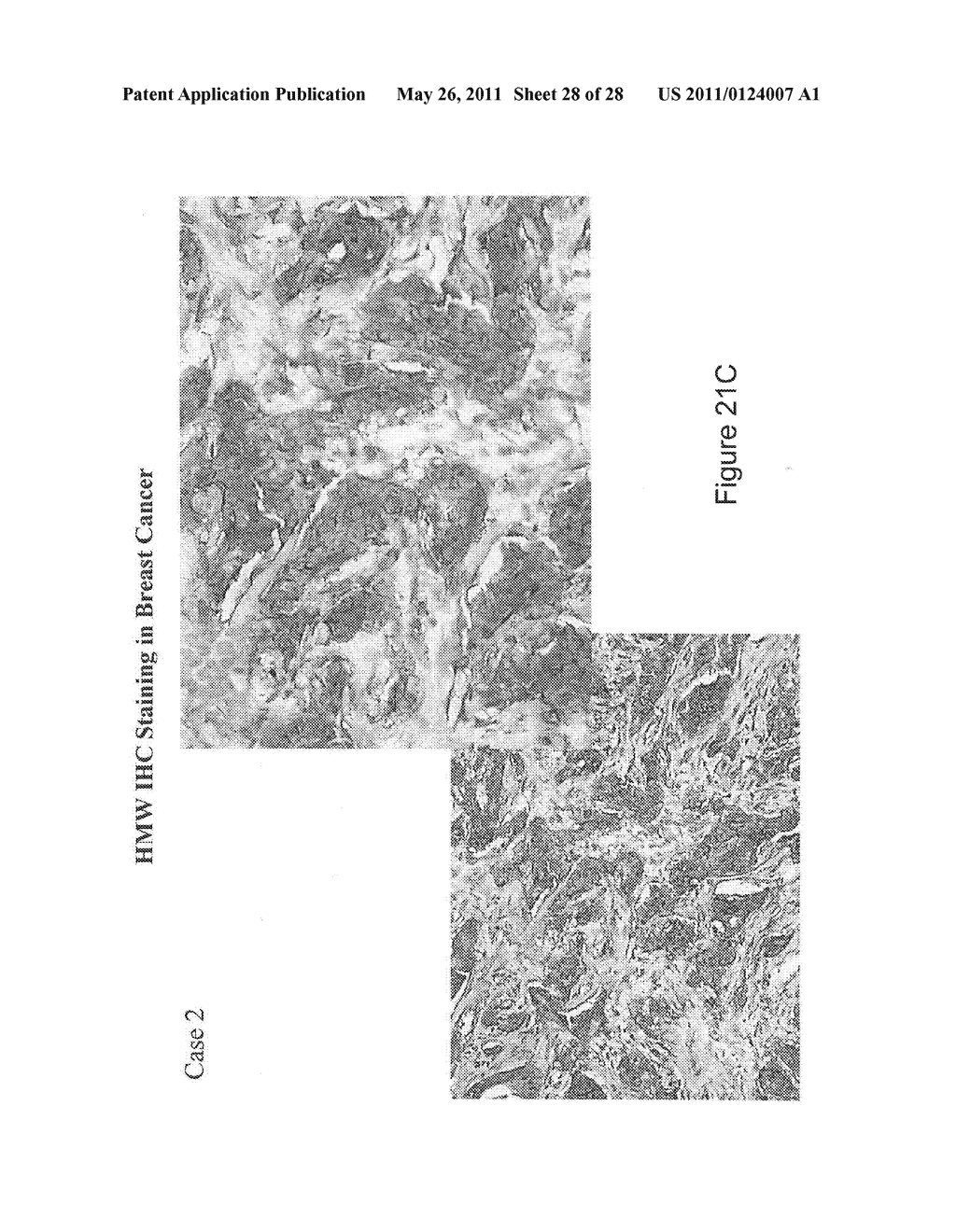 UTILITY OF HIGH MOLECULAR WEIGHT MELANOMA ASSOCIATED ANTIGEN IN DIAGNOSIS AND TREATMENT OF CANCER - diagram, schematic, and image 29