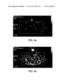 ULTRASOUND MEDIATED DRUG DELIVERY diagram and image