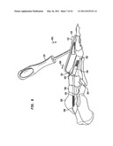 INTRAMEDULLARY FIXATION ASSEMBLY AND METHOD OF USE diagram and image