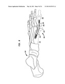 INTRAMEDULLARY FIXATION ASSEMBLY AND METHOD OF USE diagram and image