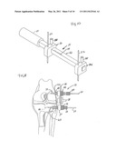 Extracapsular Surgical Procedure and Surgical Referencing Instrument Therefor diagram and image