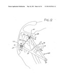 Extracapsular Surgical Procedure and Surgical Referencing Instrument Therefor diagram and image