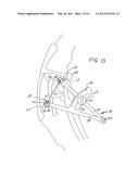 Extracapsular Surgical Procedure and Surgical Referencing Instrument Therefor diagram and image