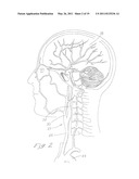 INDWELLING HEAT EXCHANGE CATHETER AND METHOD OF USING SAME diagram and image