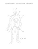 INDWELLING HEAT EXCHANGE CATHETER AND METHOD OF USING SAME diagram and image