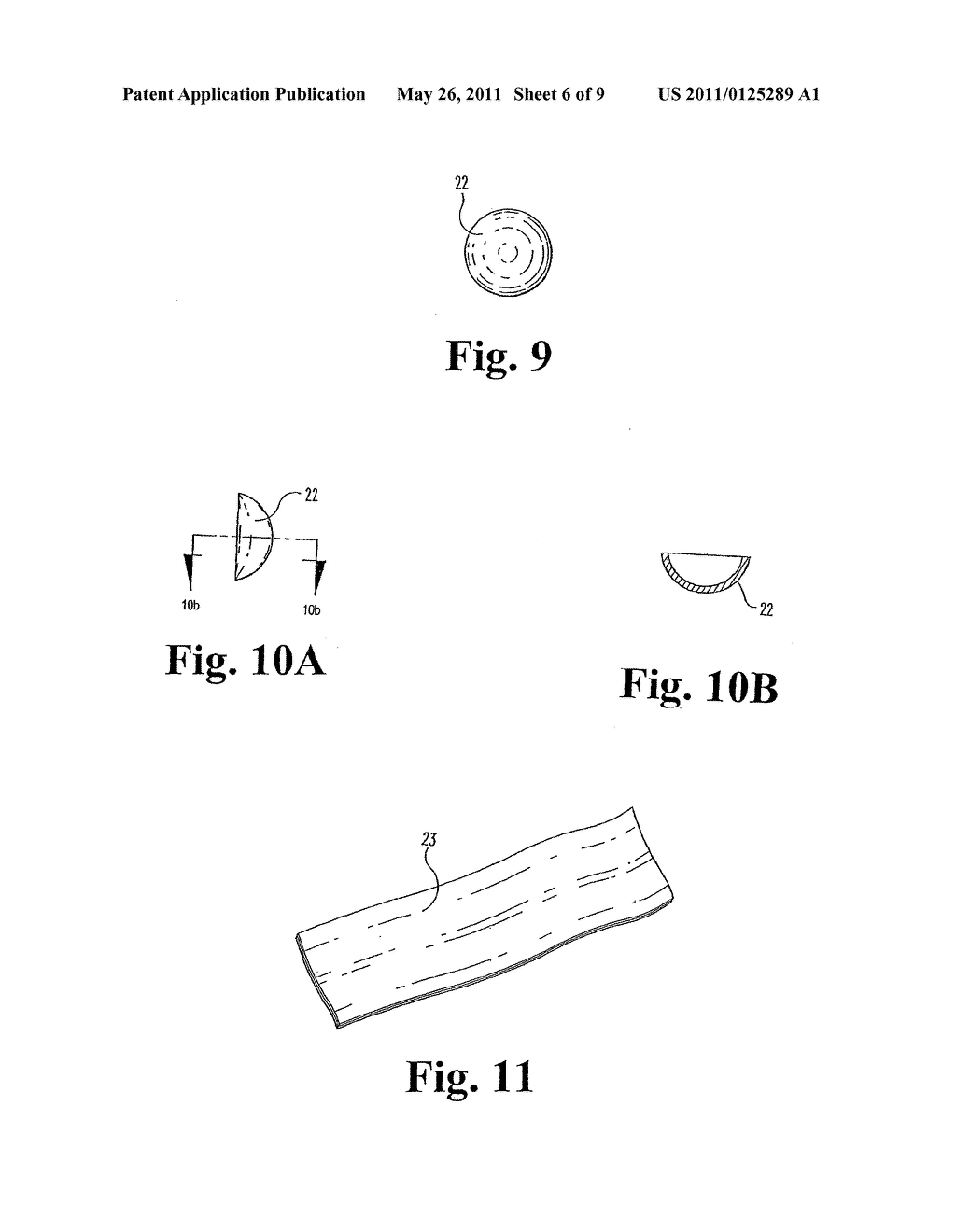 Implantable Graft to Close a Fistula - diagram, schematic, and image 07