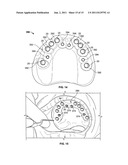 METHOD OF CREATING AN ACCURATE BONE AND SOFT-TISSUE DIGITAL DENTAL MODEL diagram and image