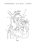 VENTRICULAR ASSIST DEVICE AND RELATED METHODS diagram and image