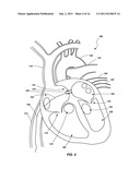 VENTRICULAR ASSIST DEVICE AND RELATED METHODS diagram and image