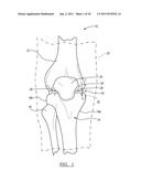 Method for Less Invasive Knee Resection diagram and image