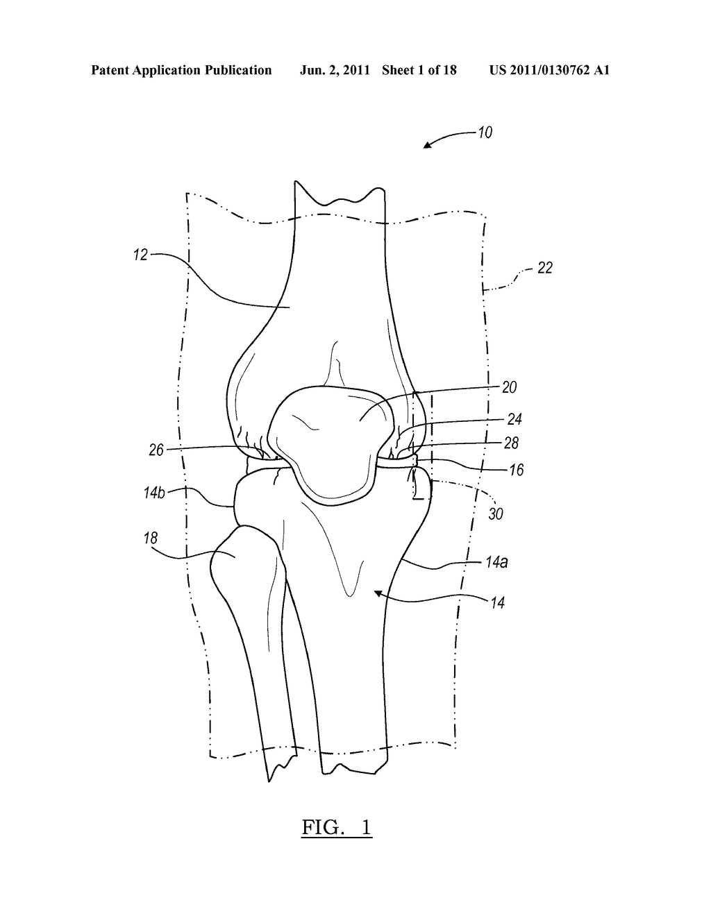 Method for Less Invasive Knee Resection - diagram, schematic, and image 02