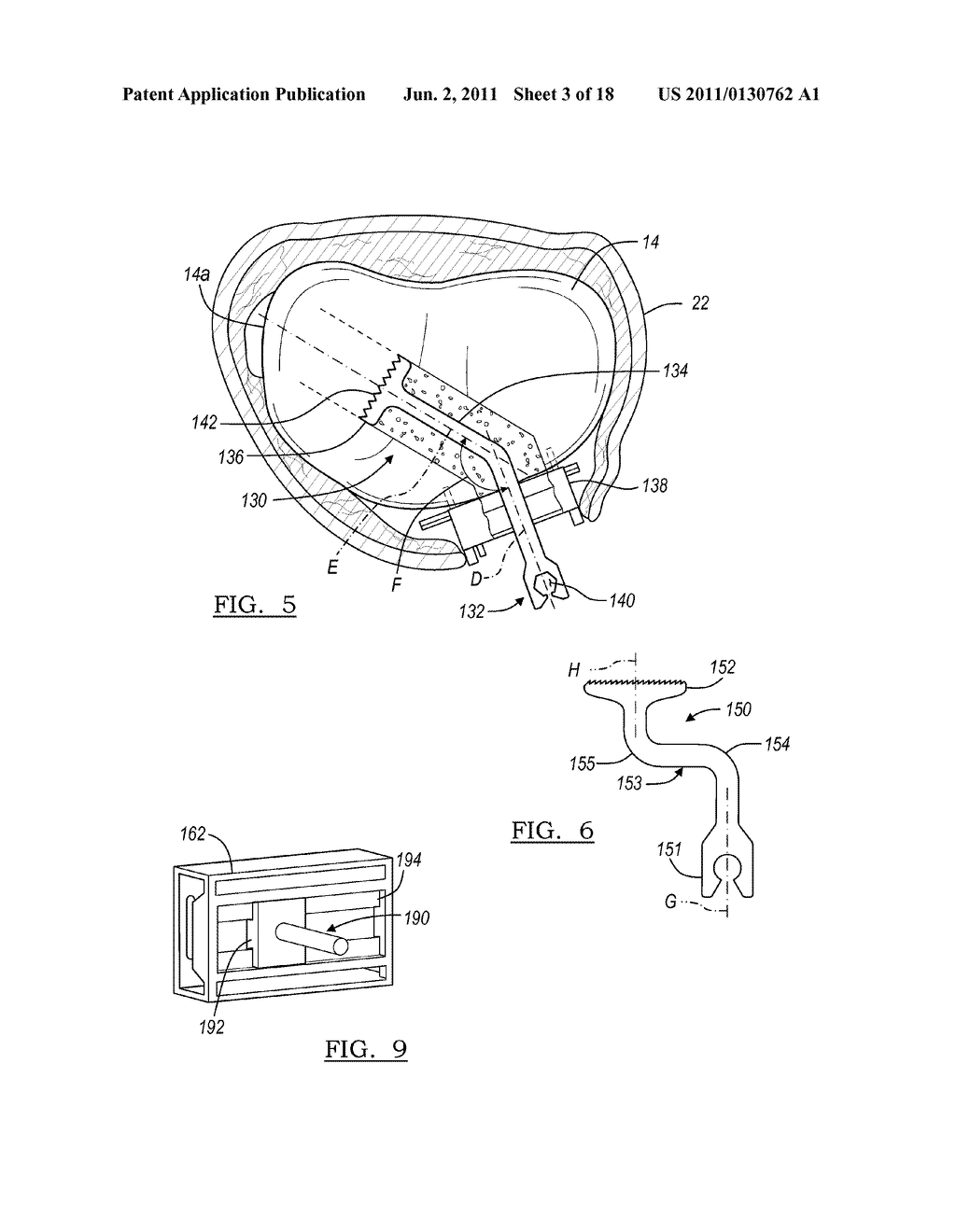 Method for Less Invasive Knee Resection - diagram, schematic, and image 04