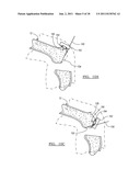Method for Less Invasive Knee Resection diagram and image