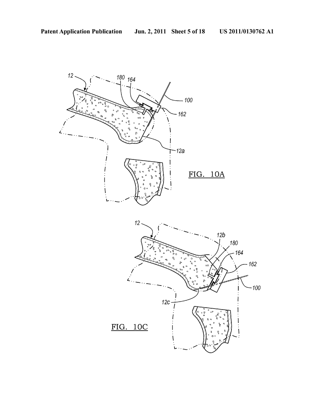 Method for Less Invasive Knee Resection - diagram, schematic, and image 06