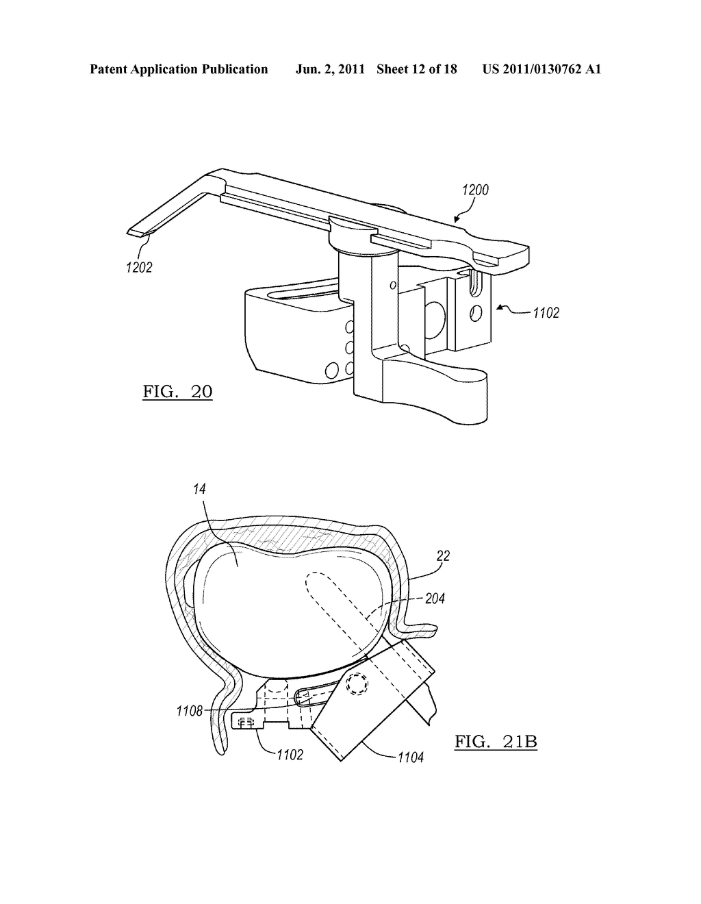 Method for Less Invasive Knee Resection - diagram, schematic, and image 13