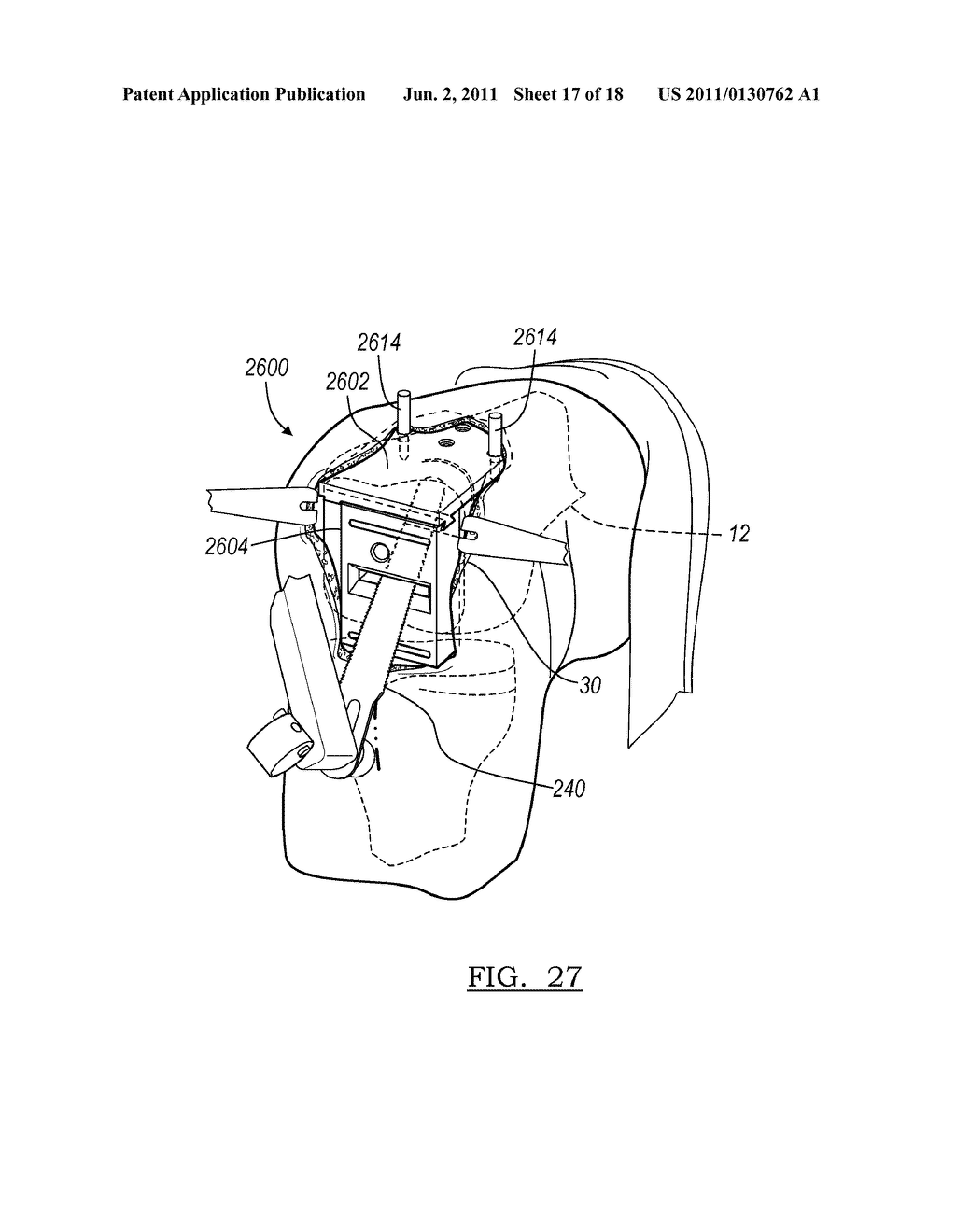 Method for Less Invasive Knee Resection - diagram, schematic, and image 18