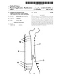 Method and Apparatus for Minimally Invasive Subcutaneous Treatment of Long     Bone Fractures diagram and image