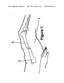 Method and Apparatus for Minimally Invasive Subcutaneous Treatment of Long     Bone Fractures diagram and image