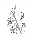 Method and Apparatus for Minimally Invasive Subcutaneous Treatment of Long     Bone Fractures diagram and image