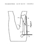 Method and Apparatus for Minimally Invasive Subcutaneous Treatment of Long     Bone Fractures diagram and image