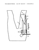 Method and Apparatus for Minimally Invasive Subcutaneous Treatment of Long     Bone Fractures diagram and image