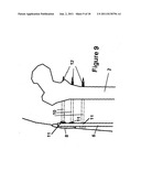 Method and Apparatus for Minimally Invasive Subcutaneous Treatment of Long     Bone Fractures diagram and image