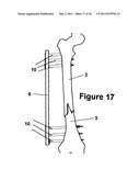 Method and Apparatus for Minimally Invasive Subcutaneous Treatment of Long     Bone Fractures diagram and image