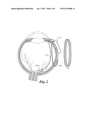 Retinal Prosthesis diagram and image