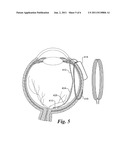 Retinal Prosthesis diagram and image
