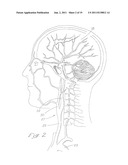 INDWELLING HEAT EXCHANGE CATHETER AND METHOD OF USING SAME diagram and image