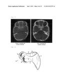 Head-Shape Remodelling Instrument diagram and image