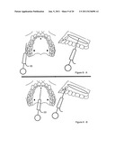 METHOD AND A DEVICE FOR PRACTICING DENTAL TREATMENTS diagram and image