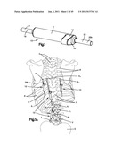 NON-FUSION SCOLIOSIS EXPANDABLE SPINAL ROD diagram and image